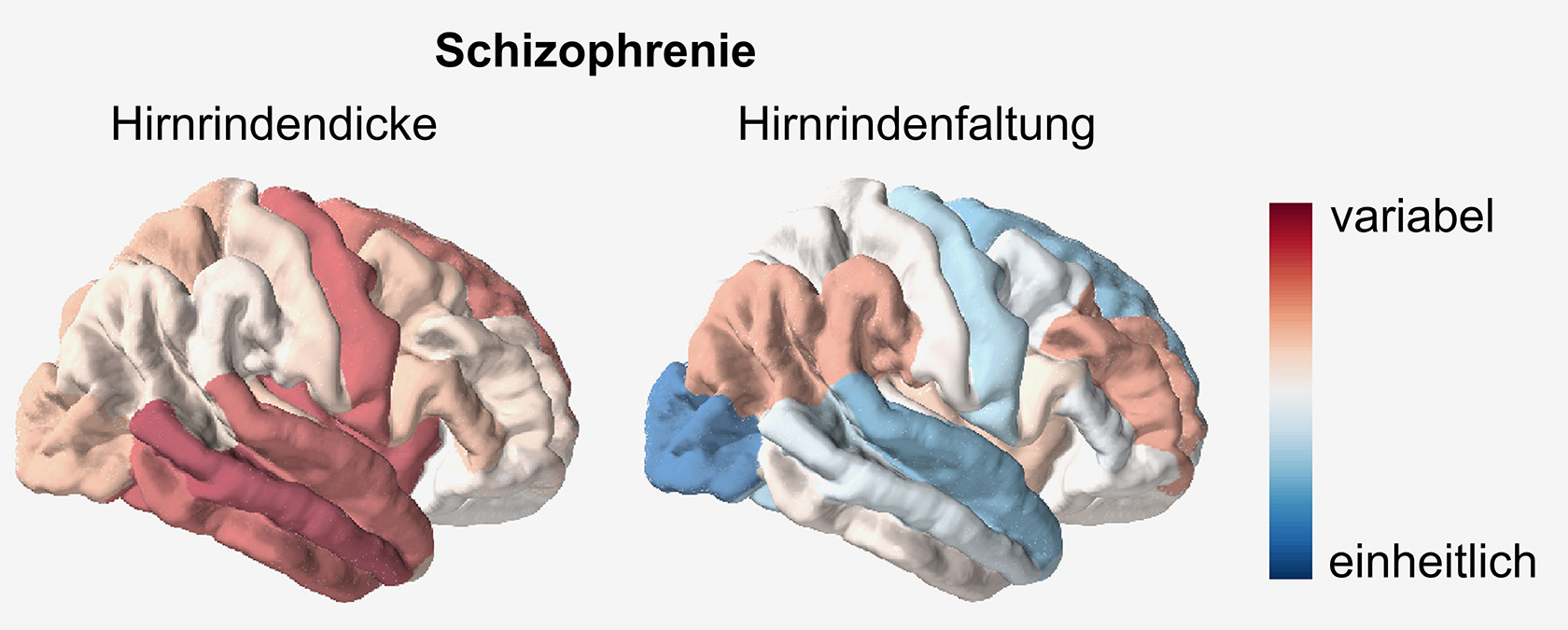 Hinrindendicke und Hinrindenfaltung bei Schizophrenie